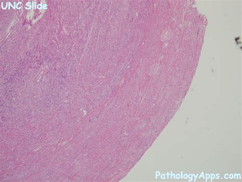 leiomyoma uterus histology