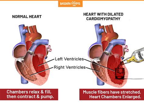 Can Alcoholic Cardiomyopathy Be Reversed? - Recovery Ranger