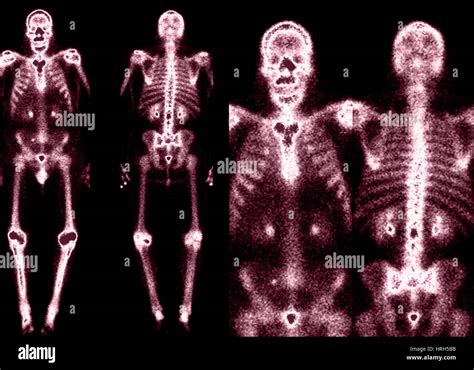 Abnormal bone scan hi-res stock photography and images - Alamy