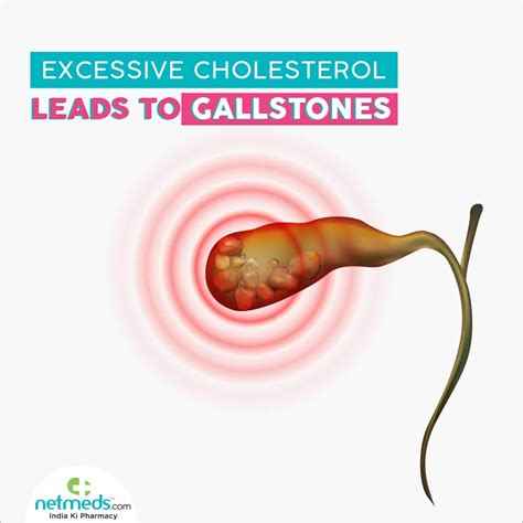 Excessive Cholesterol Leads To Gallstones