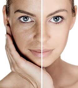 The Benefits of Chemical Peels | The Spa Clinic Arlington