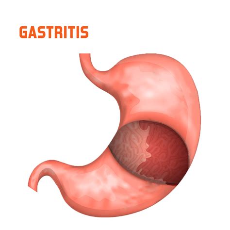 Gastritis Treatment Hospital | Gastritis Doctors Near Me, Coimbatore, Tamil Nadu, India