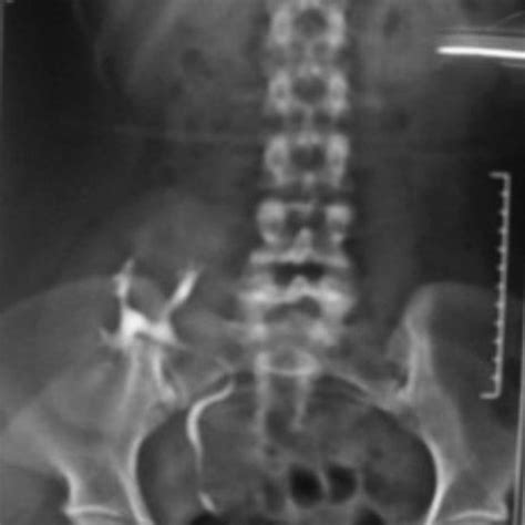 X-ray spine shows a fusion of C2–C3, C4–C5–C6 vertebrae. | Download ...