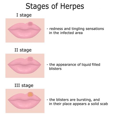 Oral Herpes: Symptoms, Causes, & Treatments