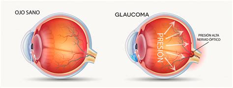 Endotelio Corneal Y Presion Intraocular Pdf Glaucoma - Mobile Legends