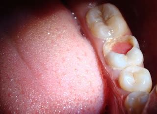 BDS INSIGHTS: Chronic Hyperplastic Pulpitis ( Pulp polyp )