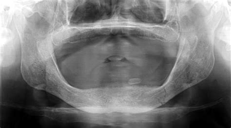 Orif Mandibular Fracture