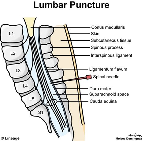 Lumbar Puncture - Neurology - Medbullets Step 1