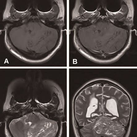 Typical MRI findings of Lhermitte-Duclos disease. T1weighted axial ...