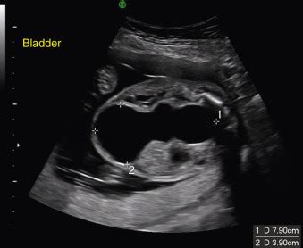 Prune-Belly Syndrome | Radiology Key