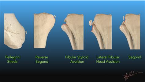 Peri-geniculate Avulsion Fractures | UW Emergency Radiology