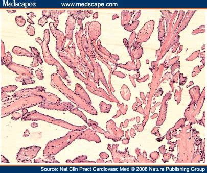 Papillary Fibroelastoma of the Aortic Valve and Coronary Artery Disease