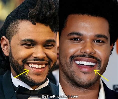 The Weeknd Plastic Surgery Comparison Photos