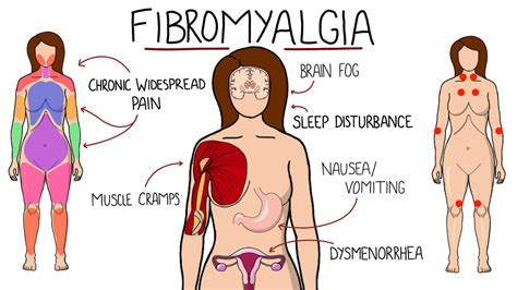 Fibromyalgia: What It Is, Symptoms, Diagnosis, and Treatment | July 2023