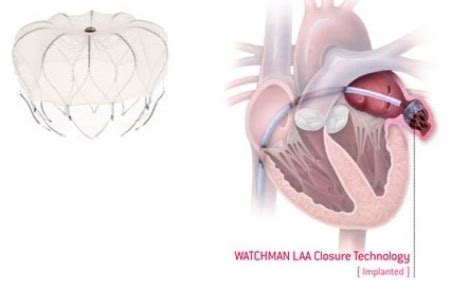 Left Atrial Appendage Closure Device - WATCHMAN