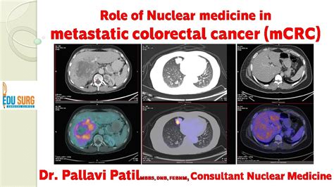 Role of PET scan/ Nuclear Medicine in the management of stage IV colon ...