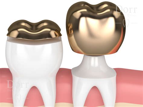 Inlay vs. Filling - Differences between dental inlays and filling