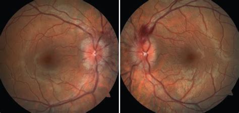 Term “Papilledema” Often Misused in the Literature