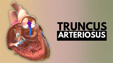 Truncus Arteriosus, Causes, Signs and Symptoms, DIagnosis and Treatment. - YouTube