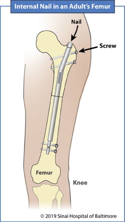 Limb Lengthening Baltimore | Height Enhancement Surgery Maryland