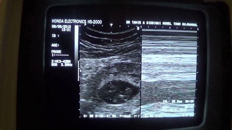 ultrasound: IUFD at 09 wks GA with subserosal FIBROID - YouTube