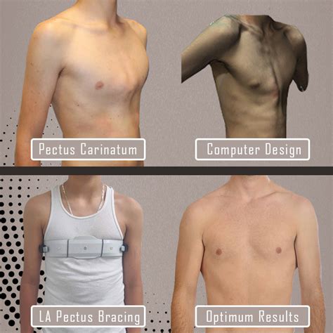 Pectus Carinatum Causes Symptoms Brace Surgery Treatm - vrogue.co