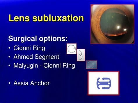 PPT - The Capsular Anchor for subluxated lenses PowerPoint Presentation - ID:696070