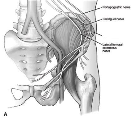 Ilioinguinal Neuralgia