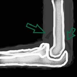 Joint Effusion: Definition, Causes, Symptoms & Treatment | Study.com