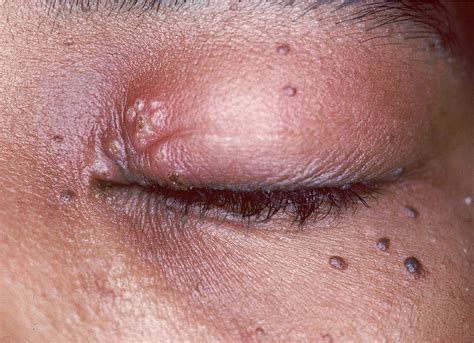 Pimple On Eyelid - Types, Causes & How To Treat Them