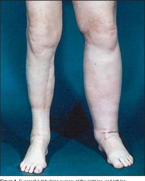 Figure 3 from Differential diagnosis, investigation, and current treatment of lower limb ...