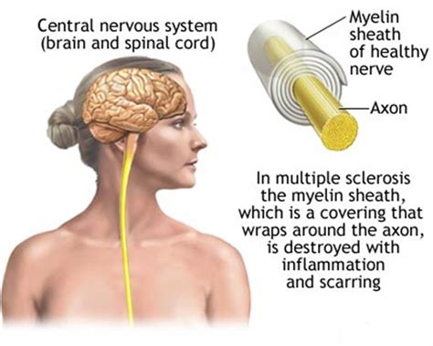 Multiple Sclerosis - Tabib.pk