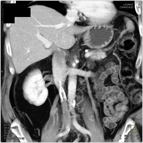 IVC Filter with Clot in IVC - Vascular Case Studies - CTisus CT Scanning