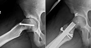 Slipped Capital Femoral Epiphysis (SCFE) | St. Louis Hip Surgeon John C. Clohisy