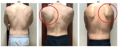 Medicina | Free Full-Text | Scapular Dyskinesis in Elite Boxers with Neck Disability and ...