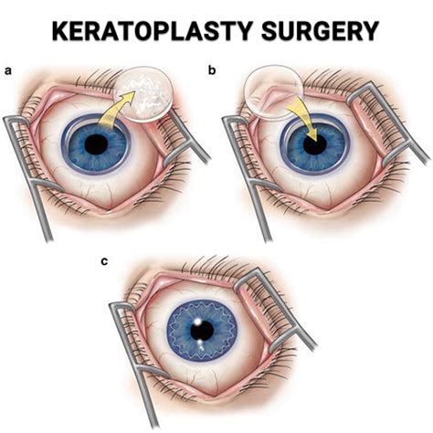 Keratoplasty in NYC - Vitreous Retina Macula Consultants of New York