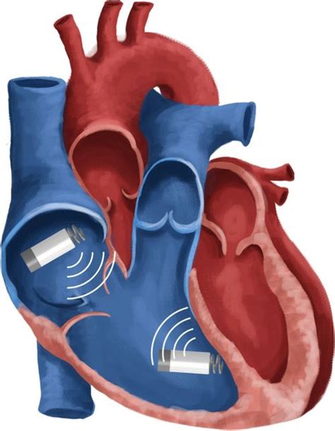 Newer frontiers in cardiac pacing : Wireless dual-chamber pacing | Dr.S.Venkatesan MD