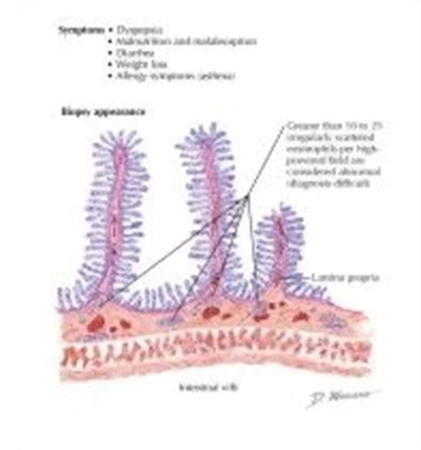 Eosinophilic Gastroenteritis