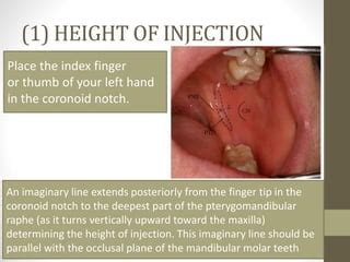 Inferior Alveolar Nerve Block Landmarks