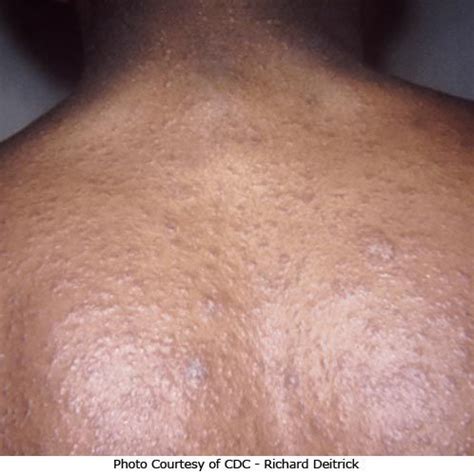 Pityriasis Rosea: Stages, Photos, Treatments