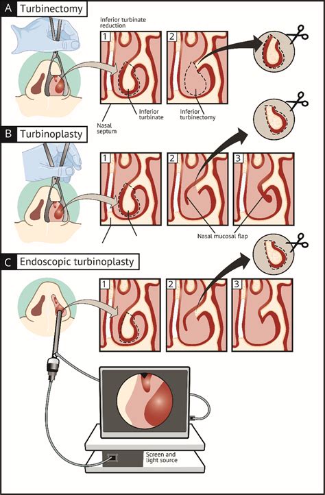 Inferior turbinate reduction: comparing post-operative bleeding between different surgical ...