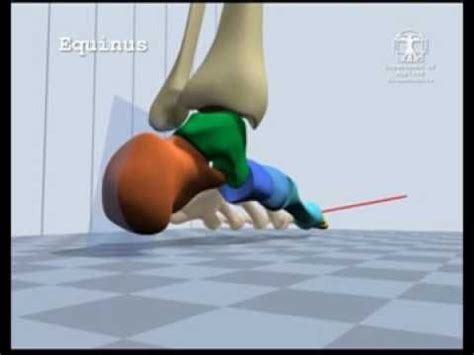 Equinus Gait | Ball exercises, Exercise, Gym