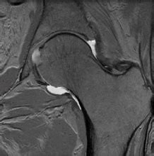 Femoroacetabular Impingement: A Patient's Guide to Hip Mobility and Hip Arthroscopy - HSS