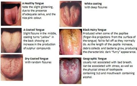 Do You Neglect The Importance Of Cleaning Your Tongue?