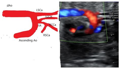 Diagnostics | Free Full-Text | Prenatal Diagnosis of Bovine Aortic Arch Anatomic Variant