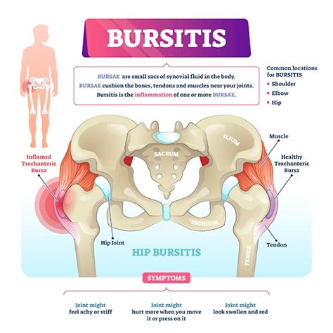 Why does my hip hurt when I walk? - Bone & Joint