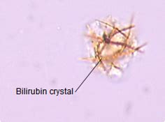 Bilirubin Crystals