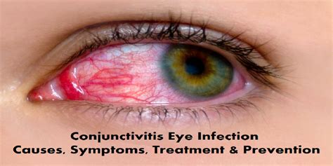 Conjunctivitis Eye Infection Causes, Symptoms, Treatment & Prevention