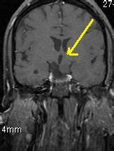 Tuber cinereum hamartoma-MRI - Sumer's Radiology Blog