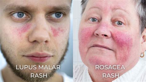 Red Alert: Lupus Rash vs. Rosacea - The Skin Mystery Unraveled – Dermeleve®